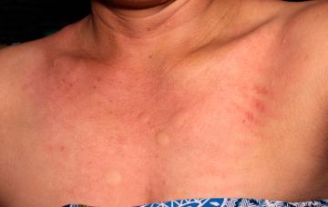 Síntomas de la alergia al níquel Mujer con dermatitis en el escote por alergia al níquel