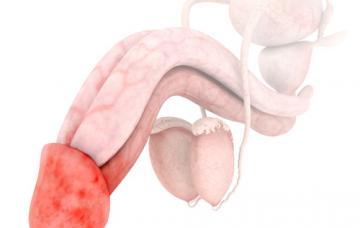 Síntomas de balanitis Síntomas y tipos de balanitis