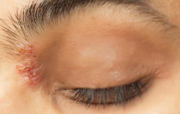 Párpado afectado por el herpes zóster