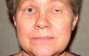 Mujer con síntomas de miastenia