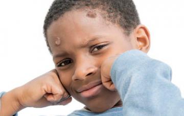 Niño con pian Niño de raza negra afectado por pian