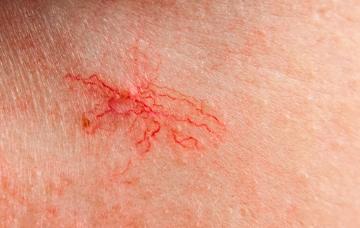 Mujer con telangiectasias en la cara