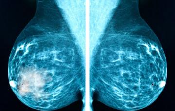 Tipos de cáncer de mama