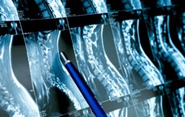 Radiografías para diagnosticar cáncer óseo