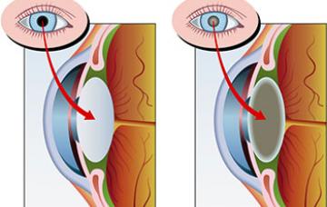 Tipos y causas de cataratas Tipos y causas de cataratas