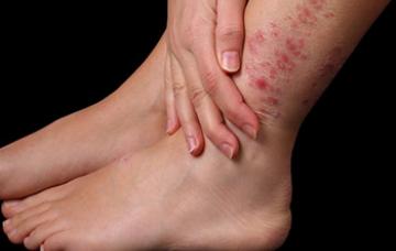 Tipos de dermatitis atópica