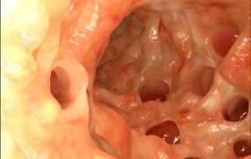 Síntomas de divertículos o bolsas en la pared del intestino grueso Síntomas de la diverticulosis