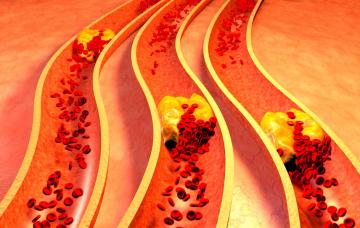 Tipos de hipercolesterolemia