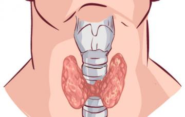 Tipos de hipotiroidismo Gráfico de la garganta