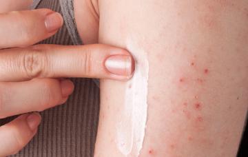 Tratamiento de la alergia al níquel Eczema en un brazo por alergia al níquel