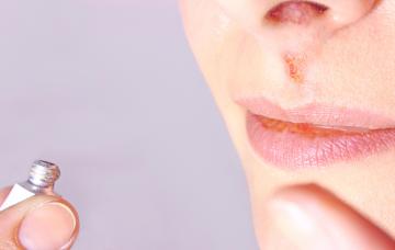 Tratamiento del herpes