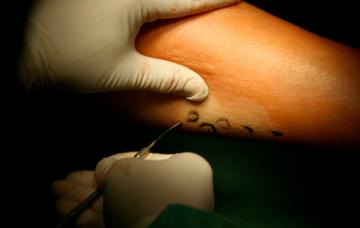 Tratamiento de las varices