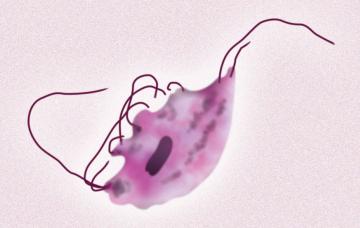 Tricomoniasis