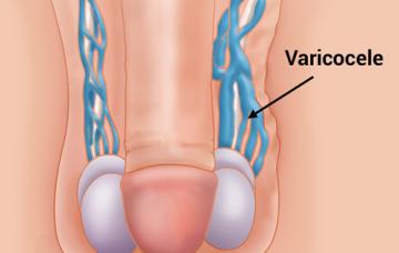 Gráfico del varicocele