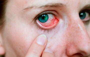 Abrasión corneal Ojos con abrasión corneal
