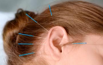 Acupuntura en la oreja
