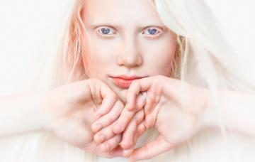 Albinismo, sin protección frente al sol Chica con albinismo, sin protección frente al sol