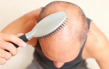 Alopecia Hombre con problemas de alopecia