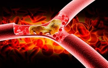 Arteriosclerosis Arteriosclerosis, cuida bien tus arterias