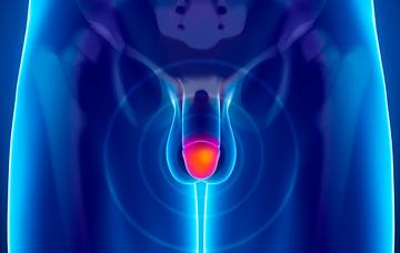 Balanitis Qué es la balanitis