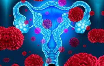 Cáncer de cuello de útero: prevenir para ganar la batalla Qué es el cáncer de cuello de útero