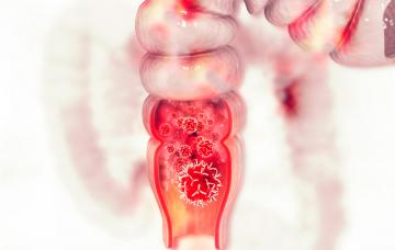 Cáncer de colon