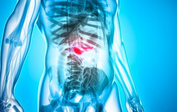 Cáncer de pancreas