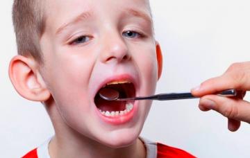 Qué son las caries