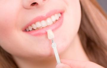 Carillas dentales, una sonrisa ‘de cine’ es posible