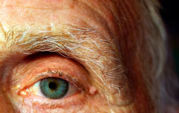 Qué son las cataratas