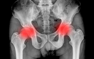 Día Mundial de la Espondilitis Anquilosante