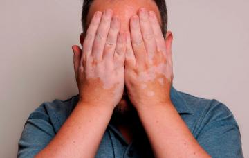 Afectados por vitíligo