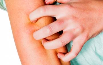 Día Mundial de la psoriasis