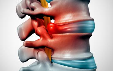 Hernia discal