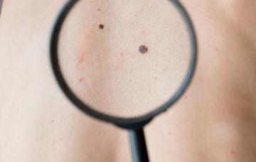 Melanoma, lunares a la lupa Melanoma