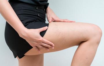 Mujer haciendo ejercicio para las varices