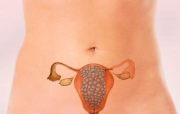 Embarazo molar, una complicación de la gestación Embarazada con mola hidatiforme, una complicación de la gestación