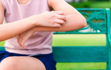 Qué es la enfermedad de Chagas Mujer rascándose el brazo por chinches que transmiten la enfermedad de Chagas