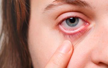 Ojo con síntomas de escleritis