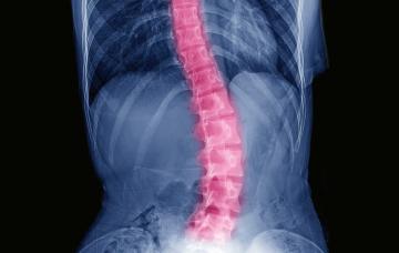 Escoliosis