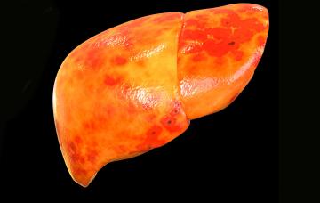 Esteatosis hepática Qué es la esteatosis hepática