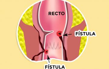 Qué es una fístula anal