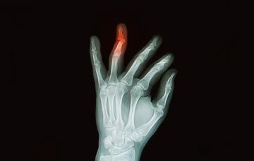 Radiografía de fractura de dedo