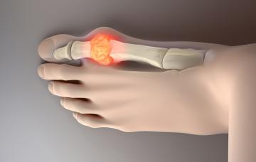 Gota y ácido úrico