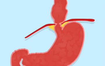 Qué es la hernia de hiato