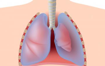 Neumotórax, afectación de los pulmones Neumotórax