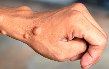 Neurofibromatosis Neurofibromatosis