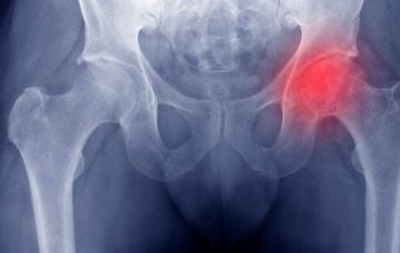 Qué es la osteonecrosis Osteonecrosis