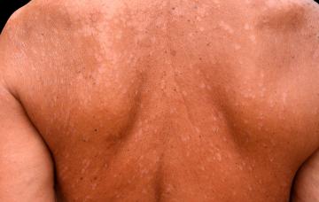 Pitiriasis versicolor o tiña versicolor Pitiriasis versicolor