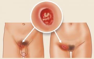 Qué es el chancro blando o chancroide